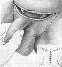 Surgery lengthens the penis by removing the hidden part